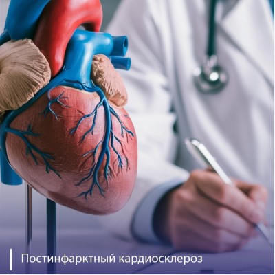 Постинфарктный кардиосклероз: что это, симптомы?