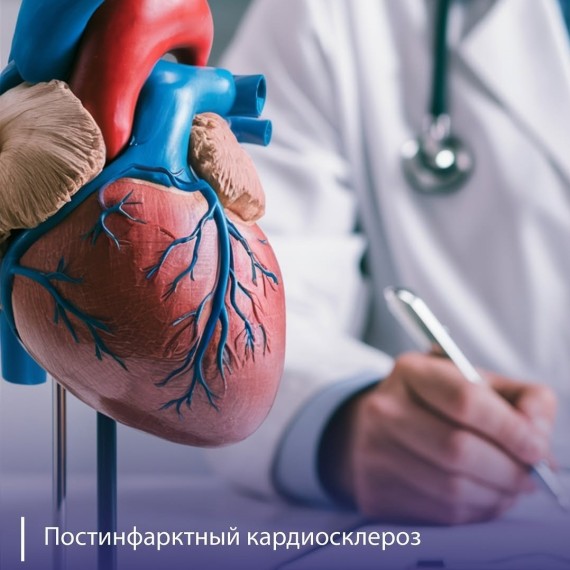 Постинфарктный кардиосклероз: что это, симптомы?