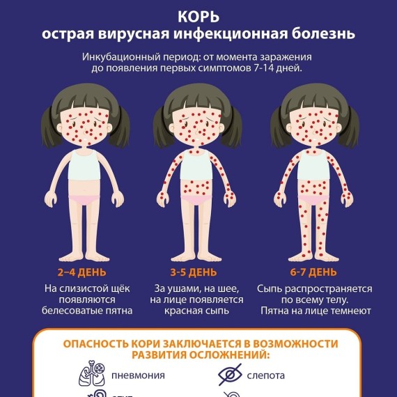 Корь у детей: как начинается и чем опасна болезнь?