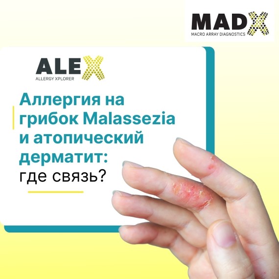 Аллергия на грибок Malassezia и атопический дерматит. Где связь?