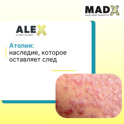 Атопия: наследие, которое оставляет след
