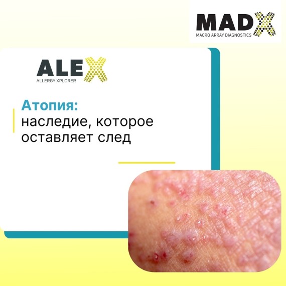 Атопия: наследие, которое оставляет след