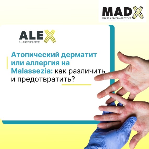 Атопический дерматит или аллергия на Malassezia: как предотвратить? 