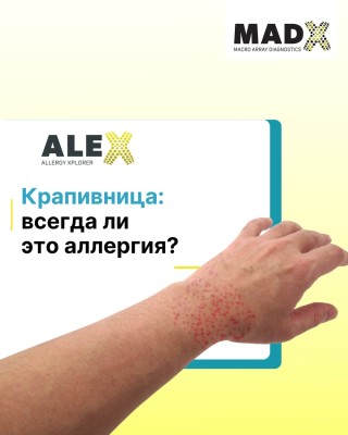 Крапивница: всегда ли это аллергия?