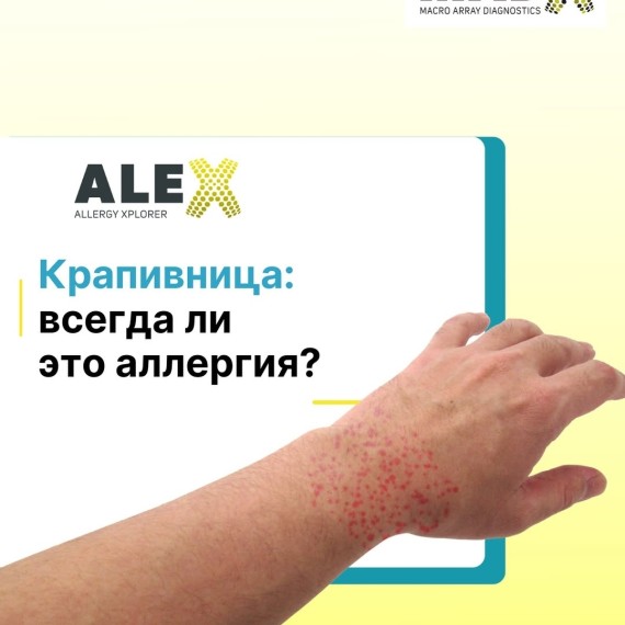 Крапивница: всегда ли это аллергия?