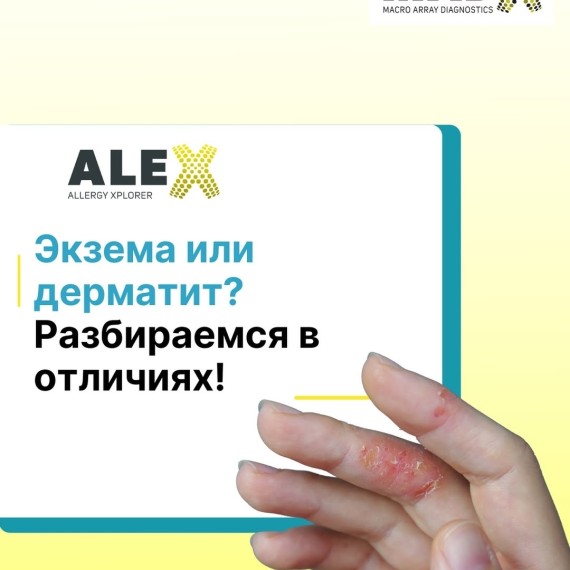 Экзема или дерматит? Разбираемся в отличиях!