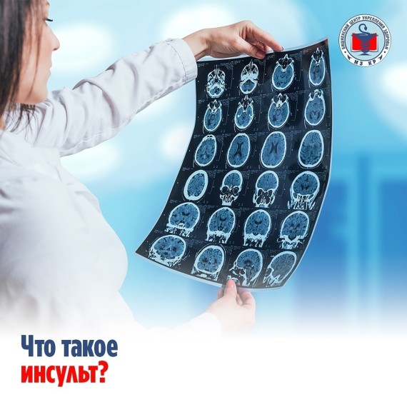 Что такое инсульт?