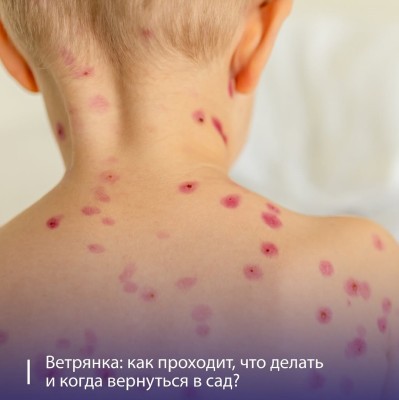 Что нужно знать о ветрянке: от симптомов до возвращения в сад?