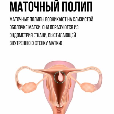 Маточный полип: симптомы, причины