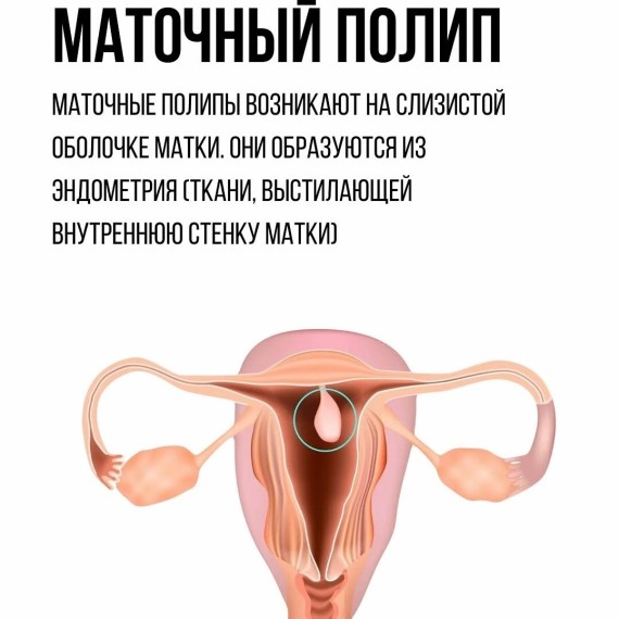 Маточный полип: симптомы, причины