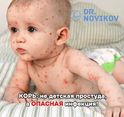 Корь: не детская простуда, а опасная инфекция!