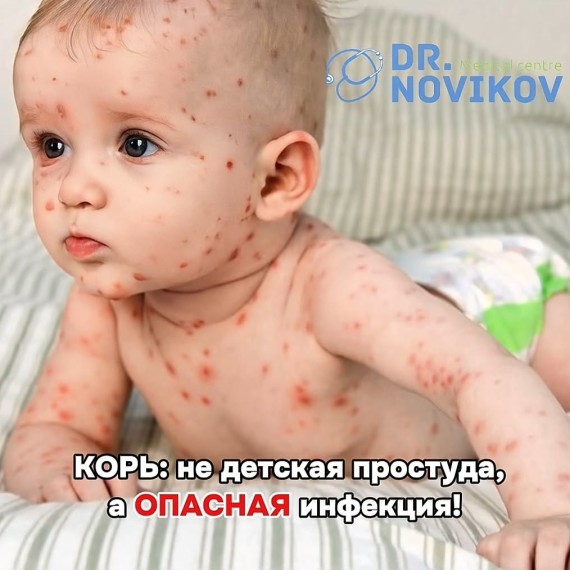 Корь: не детская простуда, а опасная инфекция!