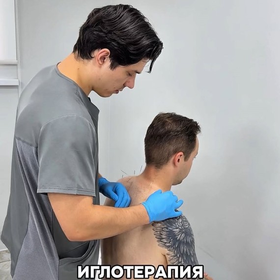 Для чего используют иглотерапию методом сухой иглы?
