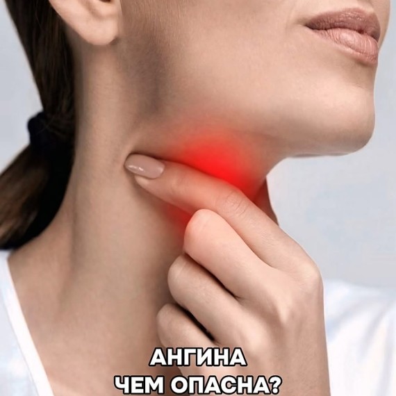 Как отличить ангину от ОРЗ или фарингита?