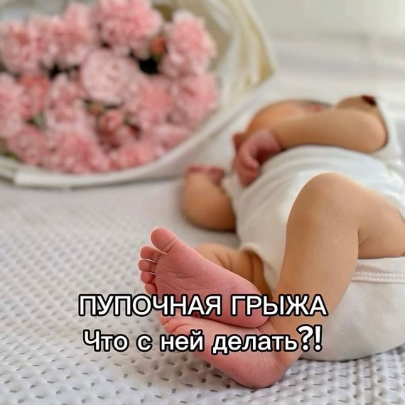 Что делать, если у малыша обнаружена пупочная грыжа? 