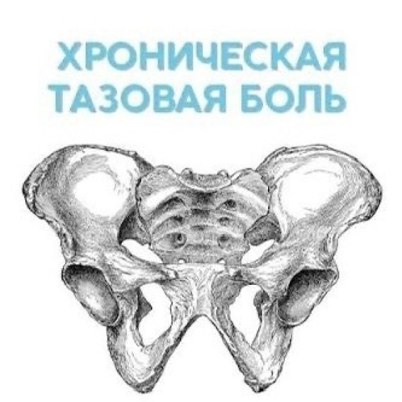 Почему возникает синдром хронической тазовой боли (ХТБ)?