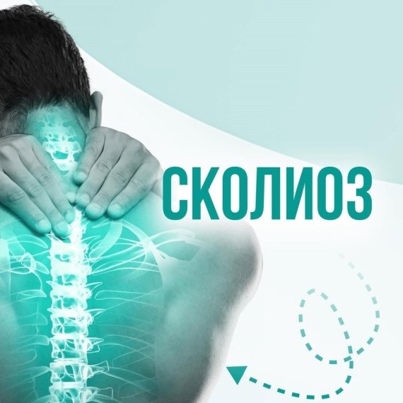 Что такое сколиоз и чем он опасен? Часть 1