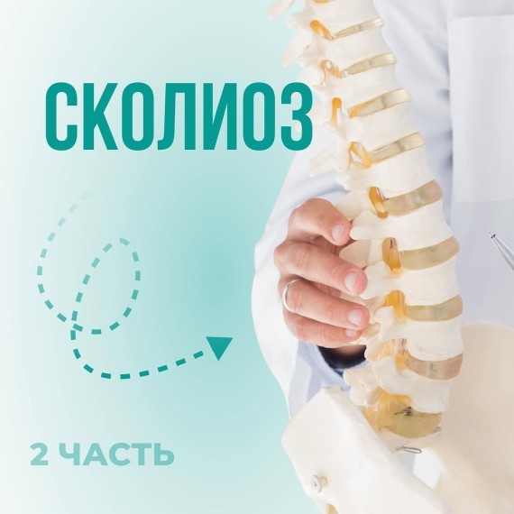 Что такое сколиоз и чем он опасен? Часть 2