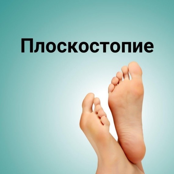 Плоскостопие и сколиоз могут быть связаны?