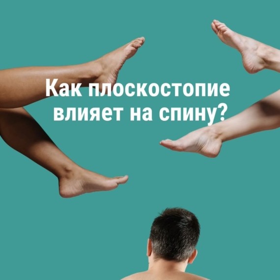 Плоскостопие и спина: скрытая связь