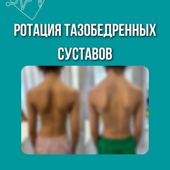 Ротация тазобедренных суставов. Что это? Как лечить?