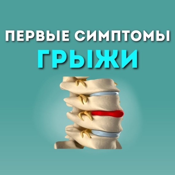 Первые симптомы грыжи: как распознать проблему на ранней стадии?