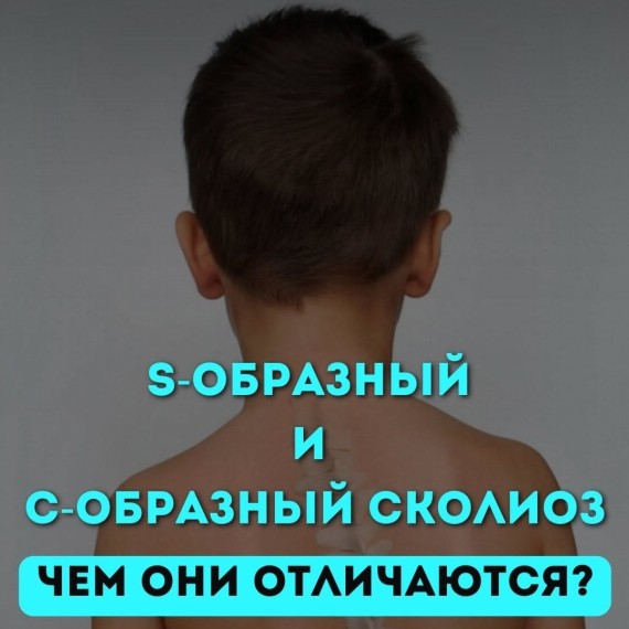 Чем отличаются S-образный и C-образный сколиоз?