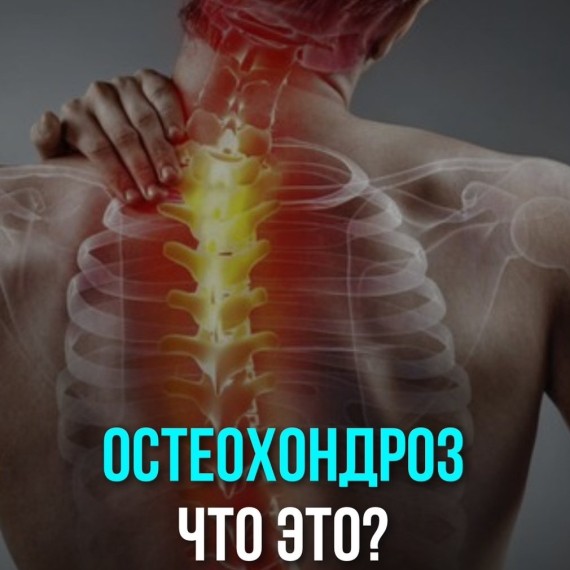 Что такое остеохондроз?