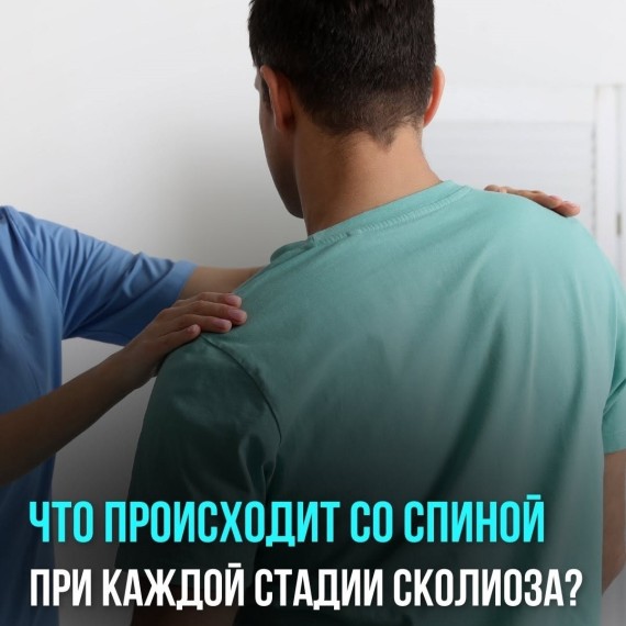 Что происходит со спиной на каждой стадии сколиоза?