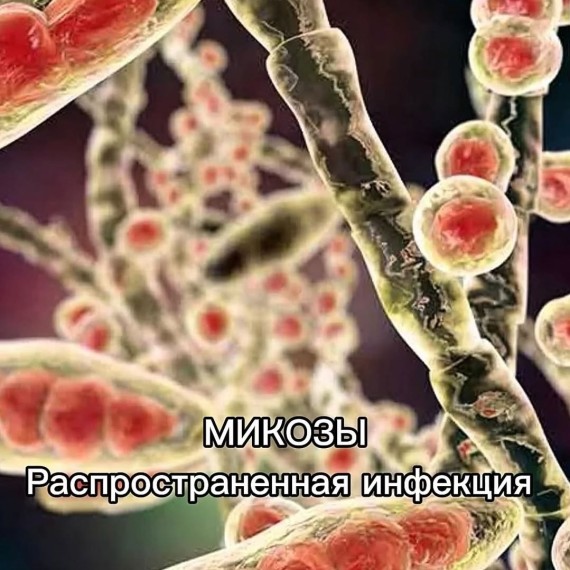 Что за болезнь микозы? 