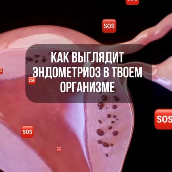 Какие последствия может давать эндометриоз?