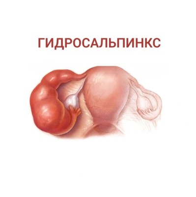 Что такое гидросальпинкс и как его лечить?