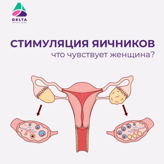 Что такое стимуляция яичников при ЭКО — и что чувствует женщина в этот период?