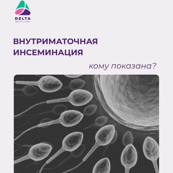Кому показана внутриматочная инсеминация (ВМИ)?