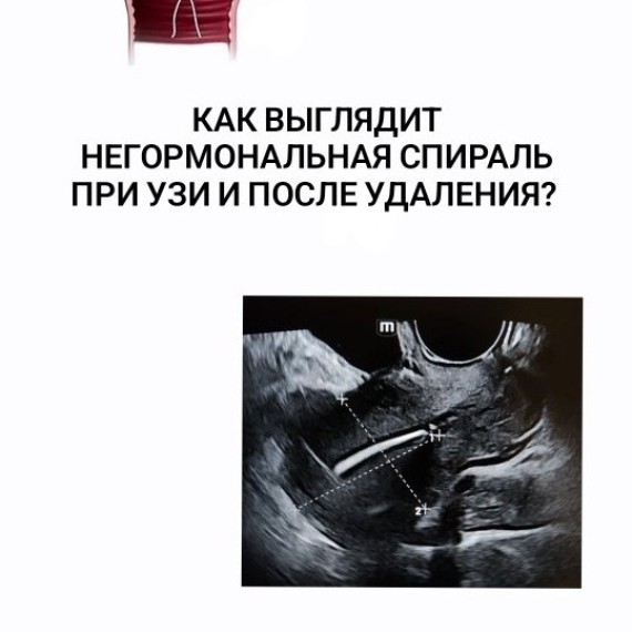 Негормональную спираль: какая она при УЗИ малого таза и сразу после удаления?
