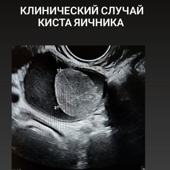Кисты яичника с кровотоком в структуре