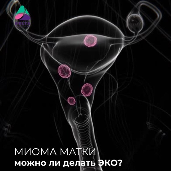 Можно ли делать ЭКО, если выявлена миома матки?