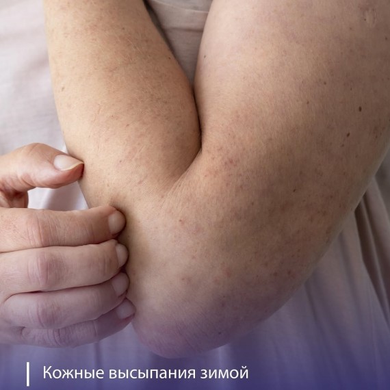Кожные высыпания зимой