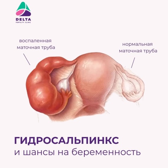 Гидросальпинкс: чем он опасен и как влияет на беременность и ЭКО?