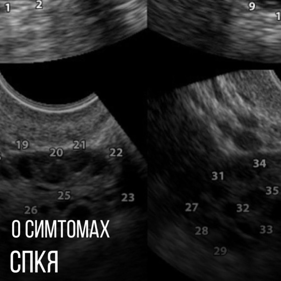 Что такое СПКЯ? Симптомы и лечение