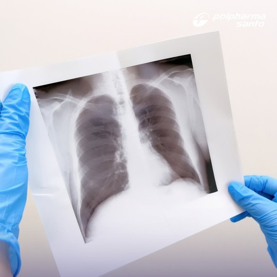 Важные факты о туберкулезе, которые спасают жизни