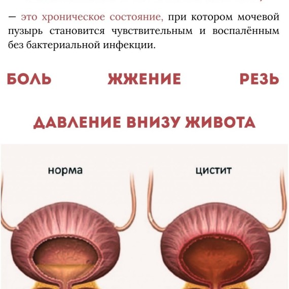 Интерстициальный цистит: что это такое ? 