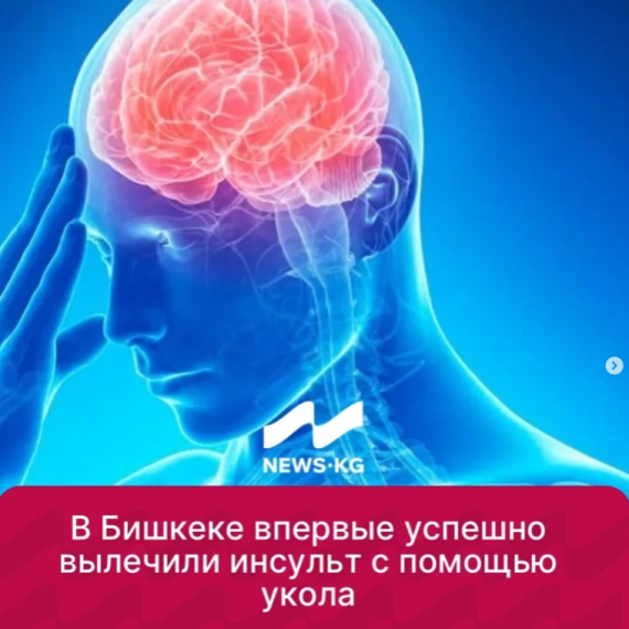 В Бишкеке впервые успешно вылечили инсульт с помощью укола