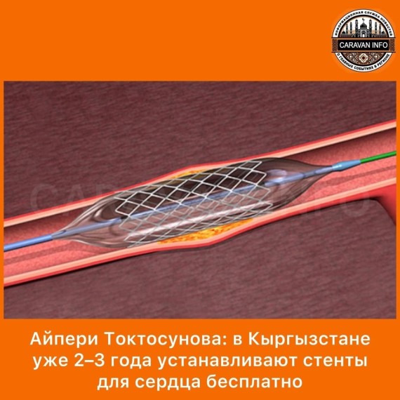 В Кыргызстане уже 2–3 года устанавливают стенты для сердца бесплатно